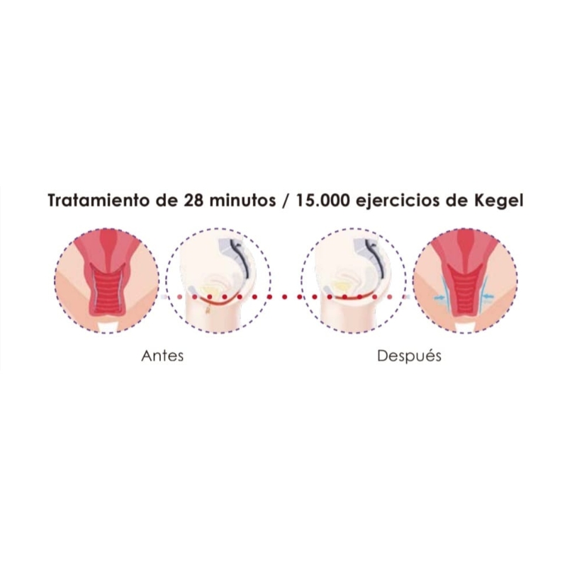 Esquema visual del tratamiento con silla de suelo pélvico en Onix Jávea